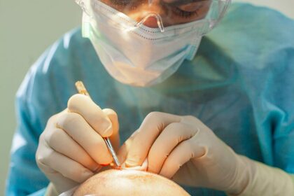Top Reasons Hair Transplants Improve Your Life Top Reasons Hair Transplants Improve Your Life